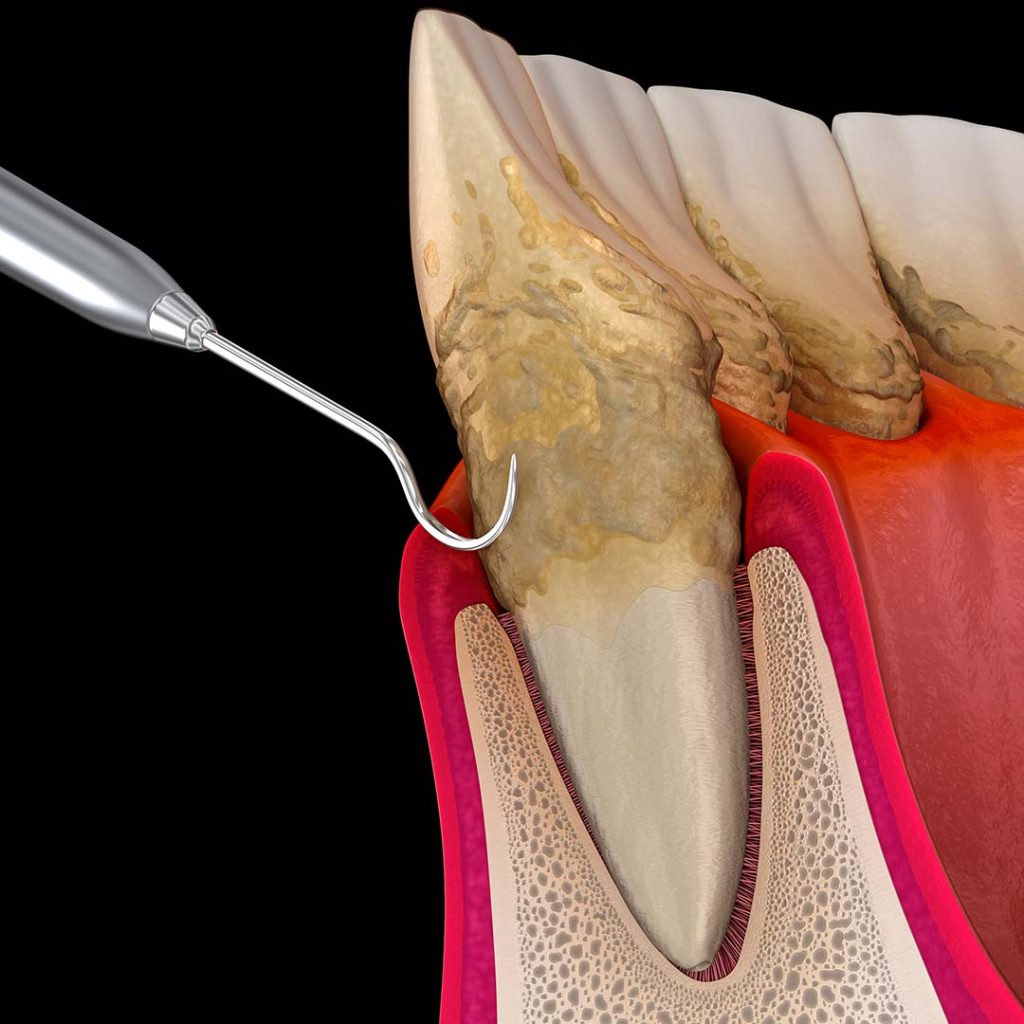 Dental professional performing scaling and root planing at Elite Dental & Wellness in Mesa, AZ