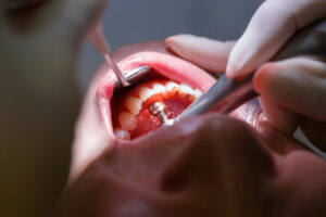 restorative dentistry at dentist office