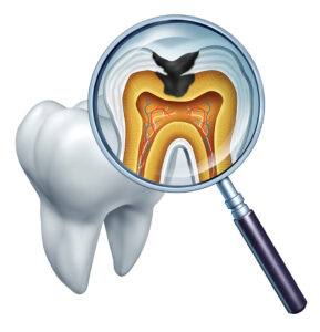 tooth surfaces
