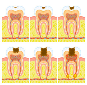 endodontics - temporary filling