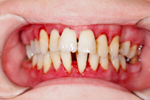 bleeding gums with moderate periodontal disease