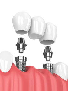 tooth enamel dental implants and porcelain crowns