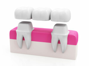 abutment teeth in dental bridge procedure with adjacent teeth
