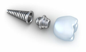 Dental Implant Service in Mesa