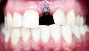 Dental Implant in gum tissue to replace missing teeth