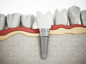 Dental Implant Virtual - ceramic dental implants
