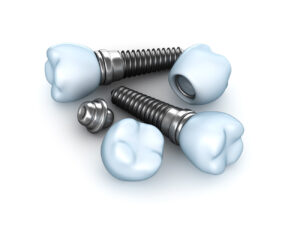 dental implants immune system surface characteristics