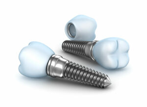 Dental Implant in Mesa