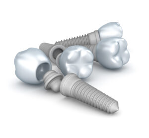 zygomatic dental implants vs traditional dental implants
