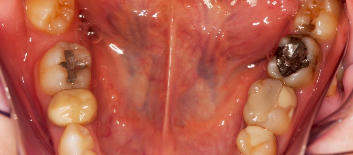 Amalgam Silver Metal Fillings - best dentist in gilbert az