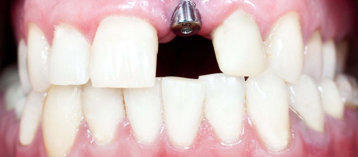 Dental Implant Installation - pediatric dentistry gilbert az