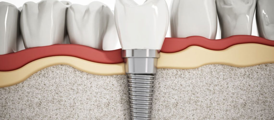 Dental Implant Virtual - ceramic dental implants