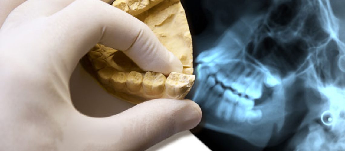 Dental X-ray Model - dental crowns gilbert az