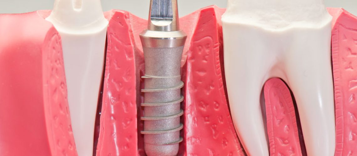 Dental Implant Sample - holistic dentistry gilbert
