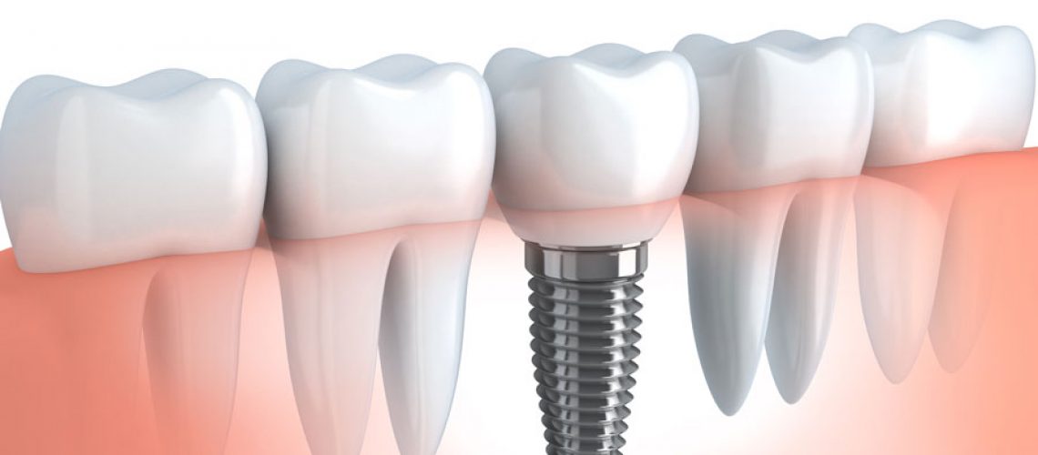 virtual-dental-implant