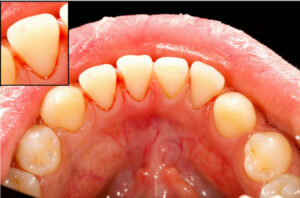 gum disease and jaw pain in subjective oral health status