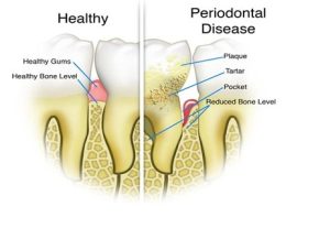 Periodontal Disease