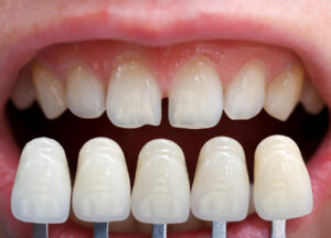restorative dental - cosmetic dental