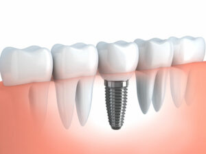 Virtual Dental Implant - mercury filling removal